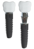 Dentist North Hollywood - Dental Implants