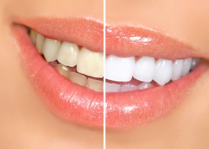 Dentist North Hollywood - Zoom Whitening