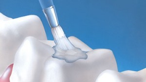 dental-sealants