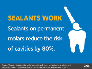 Dental Sealants - Dentist North Hollywood