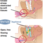 Dental Sleep Apena Appliance Modern Smiles