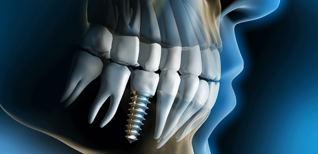 Dental Implants - Dentist North Hollywood