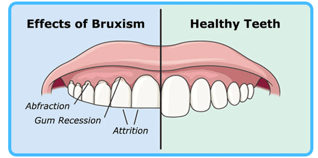 Affects of Bruxism - Dentist North Hollywood