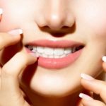 Teeth Whitening - Modern Smiles North Hollywood