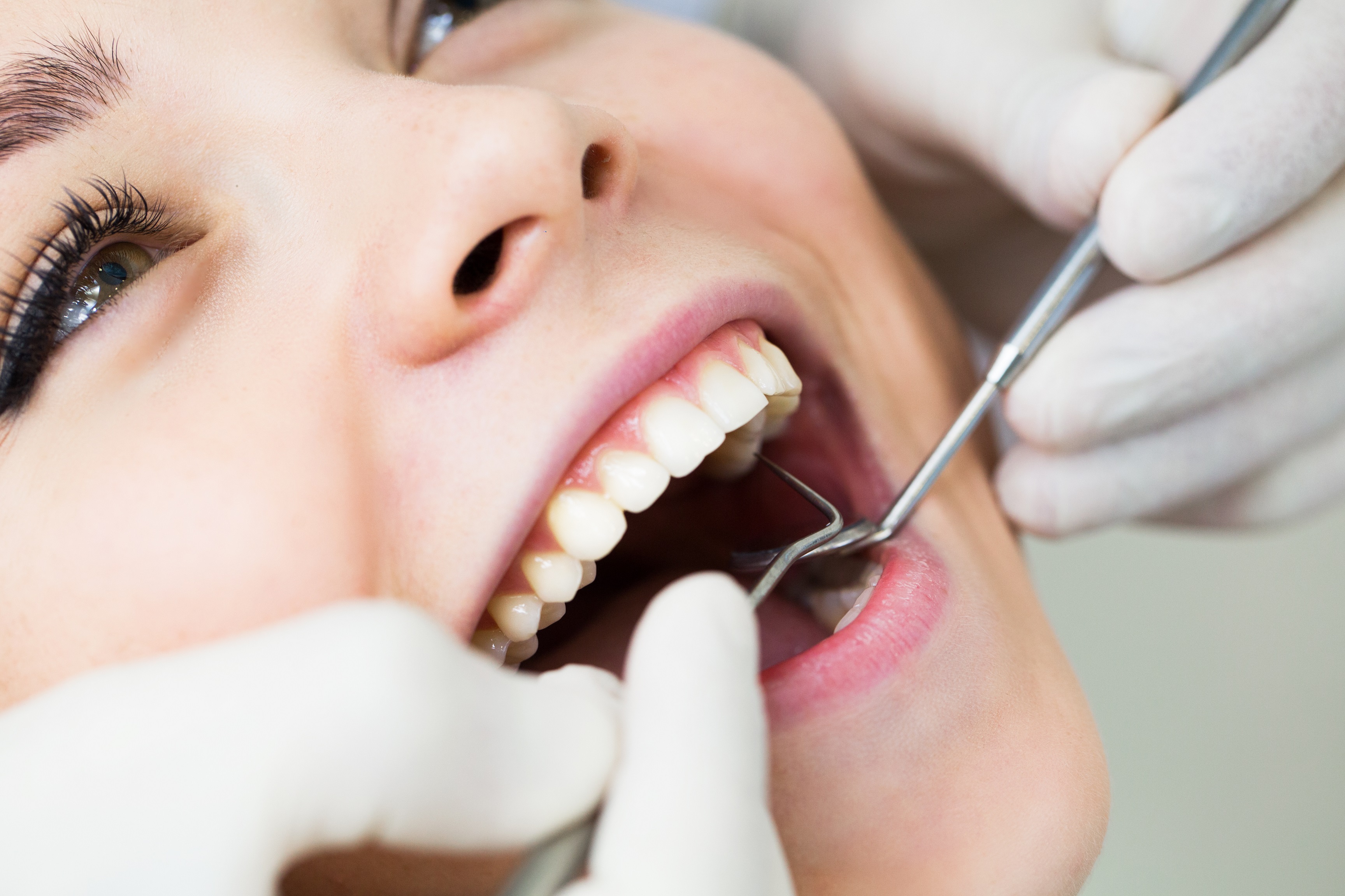 Как стоматологи делают чистку зубов. Профгигиена полости рта. Зубы стоматолог. Профессиональная гигиена. Профессиональная чистка зубов.