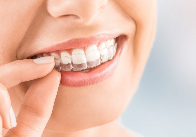 Do Clear Aligners Actually Work?