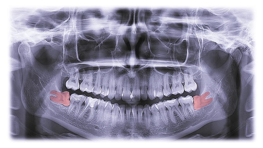 Wisdom deals teeth molars