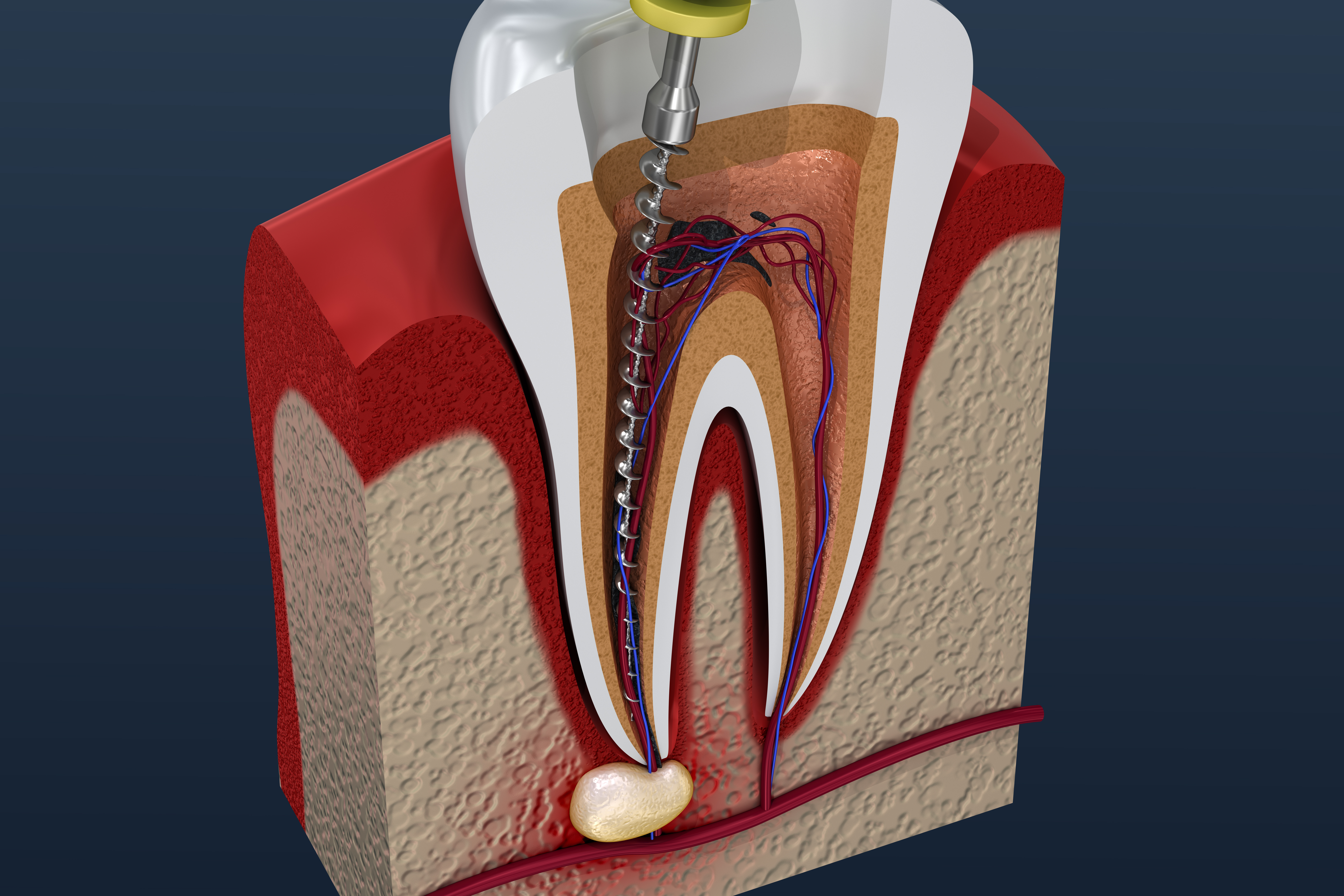Обработка и пломбирование корневых каналов. Пульпит - воспаление пульпы зуба.