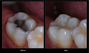 Smile Gallery Case (tooth colored composite filling)