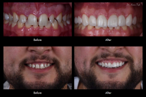 Smile Gallery Case (porcelain veneers)