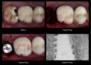 Smile Gallery Case (Implant) 