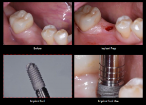 Smile Gallery Case (Implant)