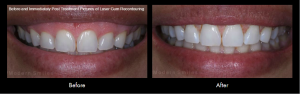 Smile Gallery Case (laser gum recontouring)