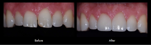 Smile Gallery Case (porcelain veneers)