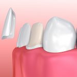 improving smiles with porcelain veneers