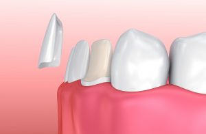 improving smiles with porcelain veneers