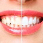 whiter teeth in one visit