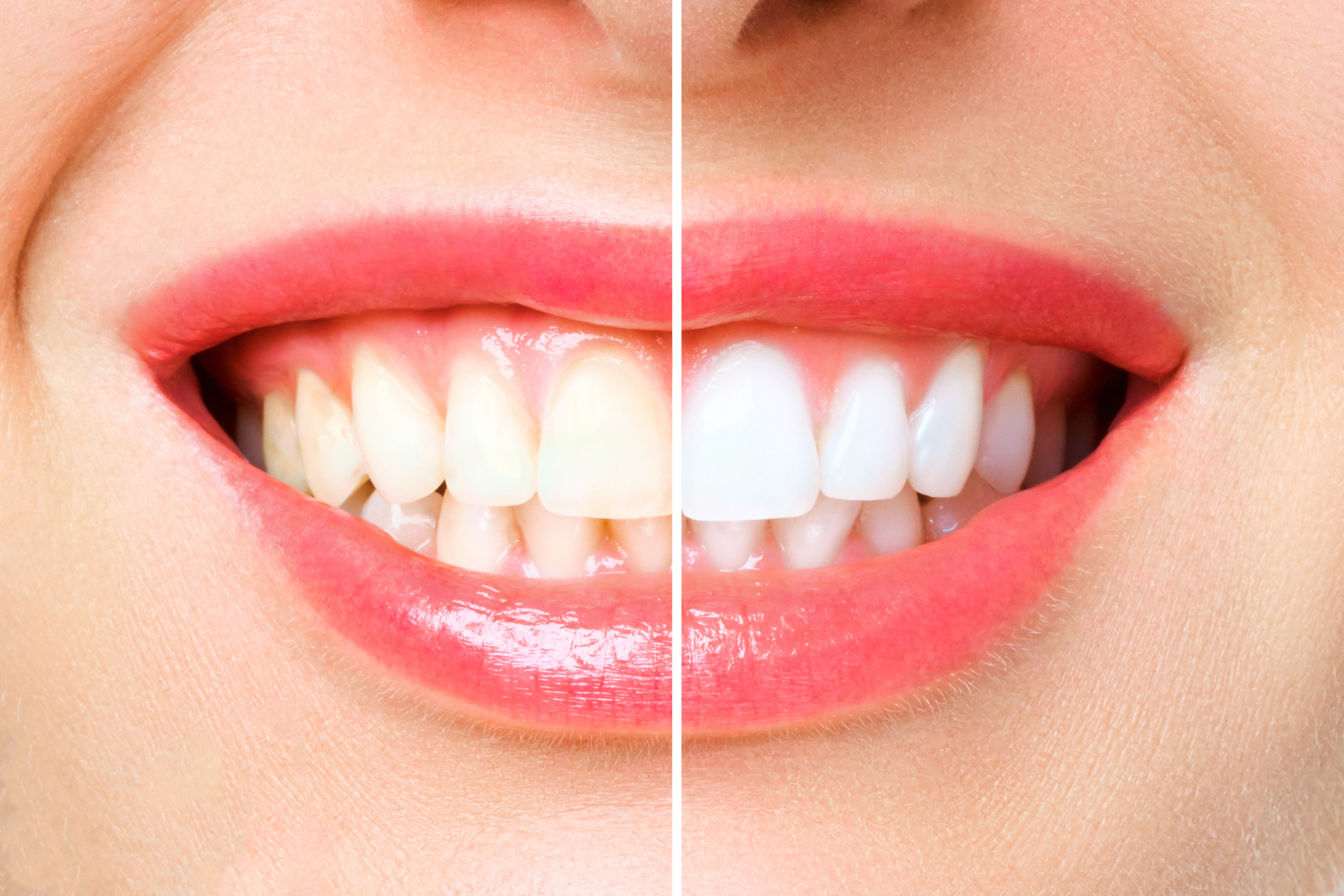 Отбеливание полости рта. Белые зубы. Красивые белые зубы. Отбеливание зубов до и после. Зубы до и после отбеливания.