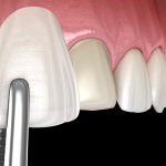 placing porcelain veneers