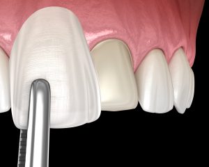 placing porcelain veneers