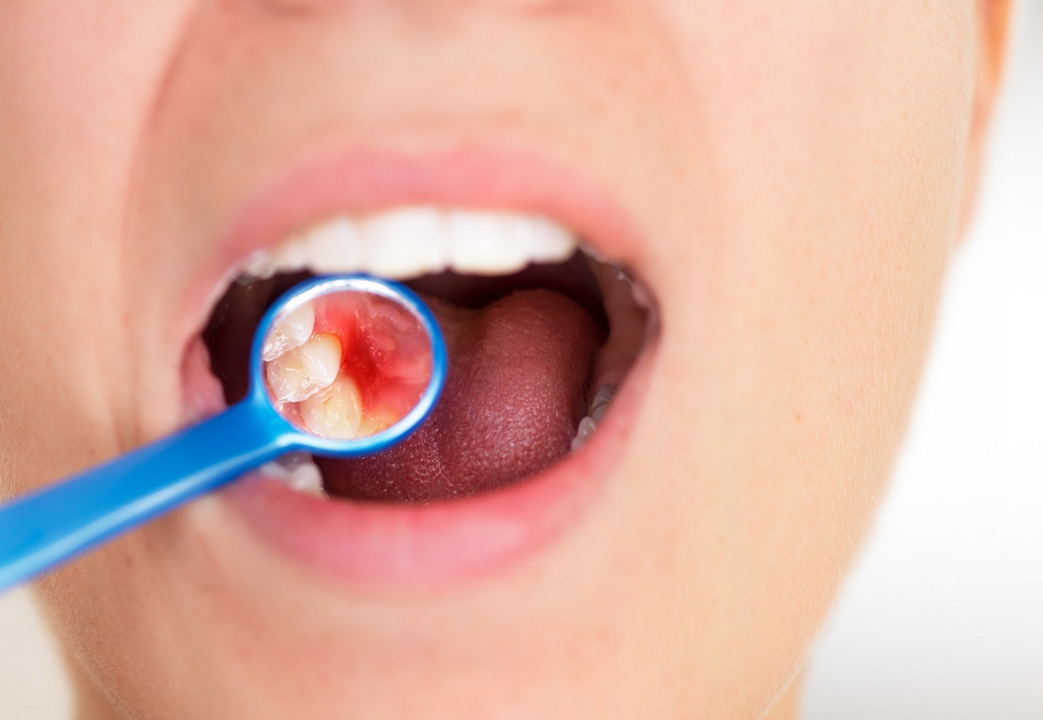 Important Facts About Gum Disease You Should Know