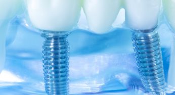 Answering Questions About Dental Implant Restorations