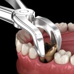 North Hollywood Dental Extraction