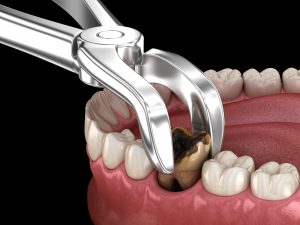 North Hollywood Dental Extraction