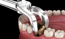 North Hollywood Dental Extraction