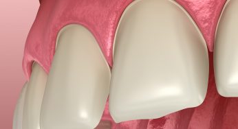 Things Porcelain Veneers Can Fix Almost Instantly