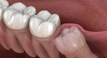 When Wisdom Teeth Become Worrisome