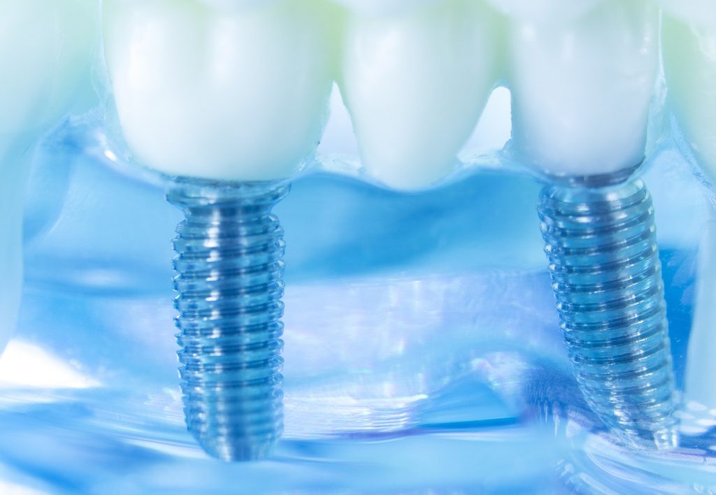 answers-to-questions-about-dental-implants