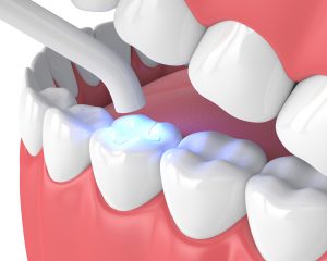 3d render of jaw with dental polymerization lamp and light cured inlay filling over white background