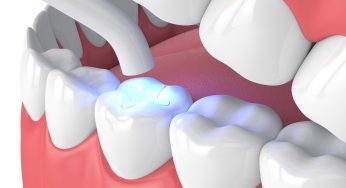 How Your Tooth Can Benefit from a Shade-Matched Filling