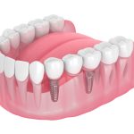 3d render of jaw with implants supported dental bridge isolated over white background