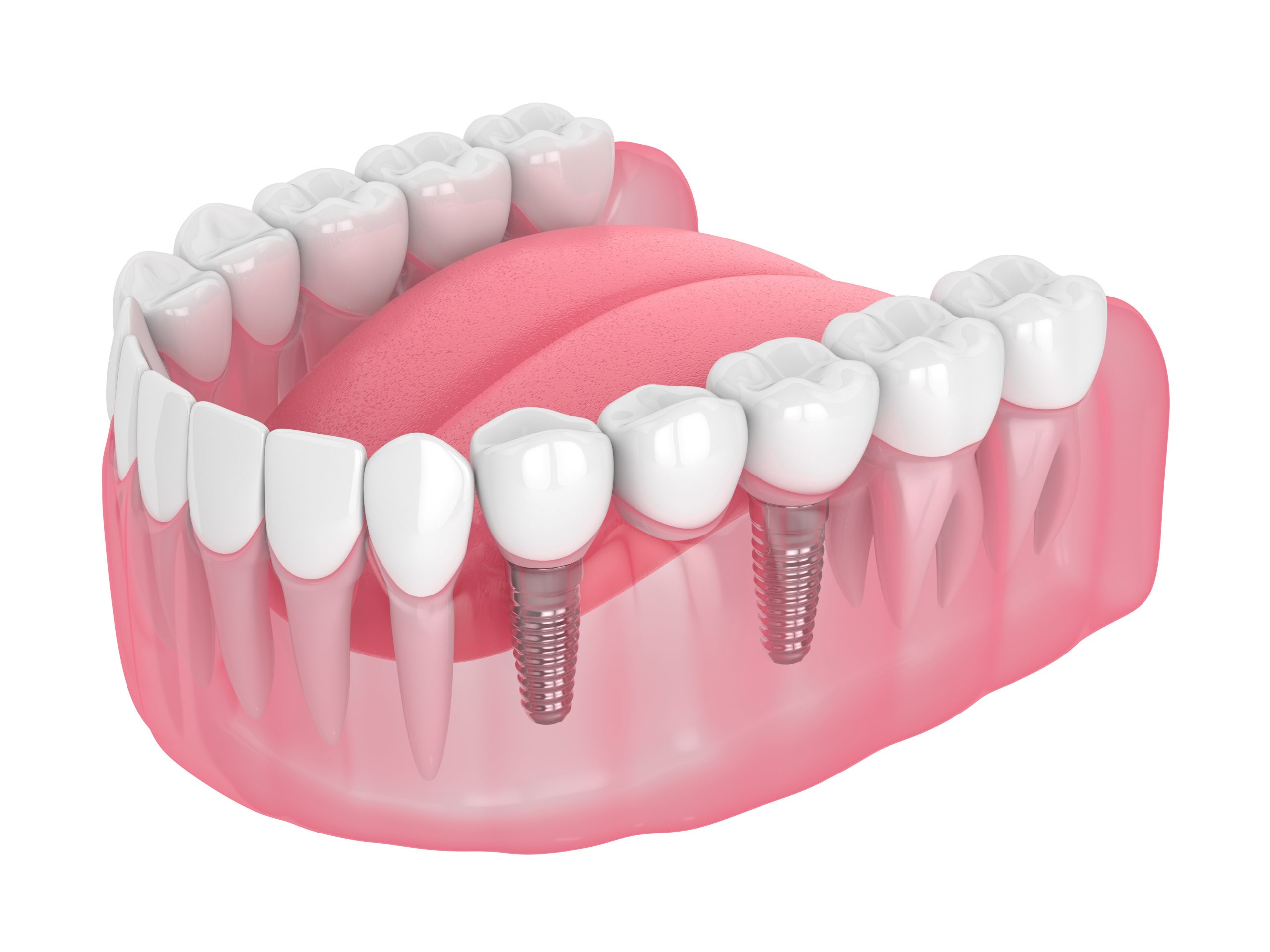3d render of jaw with implants supported dental bridge isolated over white background