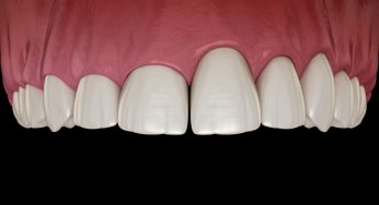 Three Benefits of Gum Contouring