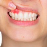 Closeup portrait of young woman showing, with his finger, inflamed upper gingiva with pain expression. Dental care and toothache.