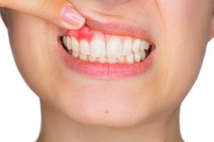 Closeup portrait of young woman showing, with his finger, inflamed upper gingiva with pain expression. Dental care and toothache.