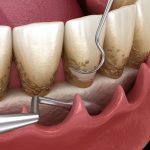 Open curettage: Scaling and root planing (conventional periodontal therapy). Medically accurate 3D illustration of human teeth treatment