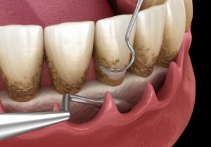 Open curettage: Scaling and root planing (conventional periodontal therapy). Medically accurate 3D illustration of human teeth treatment