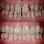 The natural-looking smile makeover with the dental ceramic veneer and crown