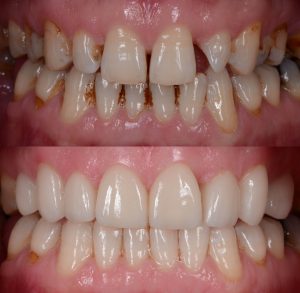 The natural-looking smile makeover with the dental ceramic veneer and crown