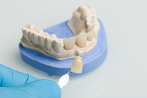 Using a shade guide to check veneer of denture parts in a dental laboratory