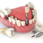 Tooth human implant. Dental concept. Human teeth or dentures. 3d illustration