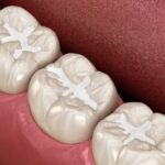 Molar Fissure dental fillings, Medically accurate 3D illustration of dental concept