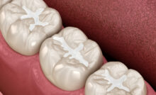 Molar Fissure dental fillings, Medically accurate 3D illustration of dental concept