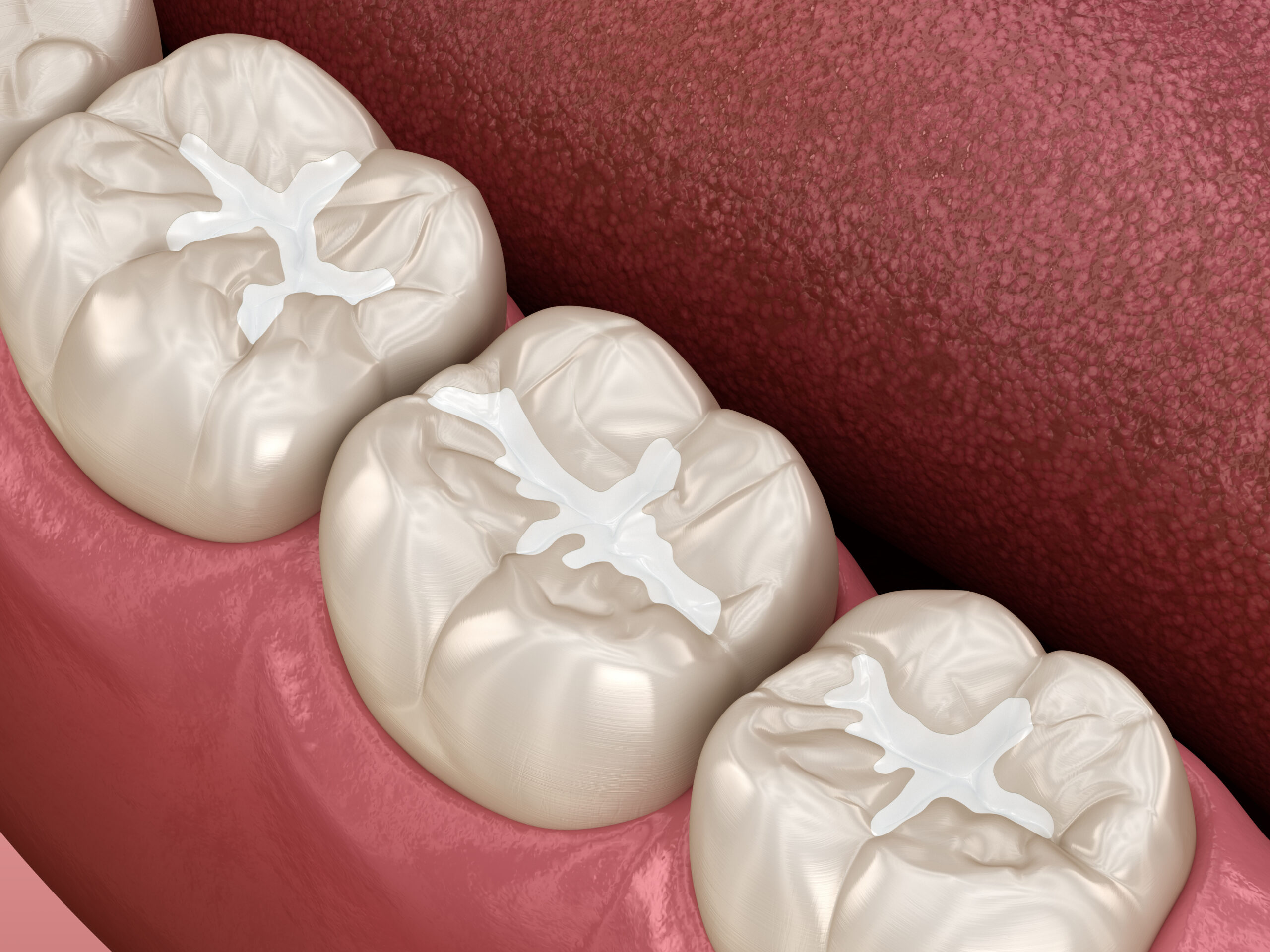 Molar Fissure dental fillings, Medically accurate 3D illustration of dental concept