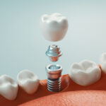 Dental care, dental implant, 3d rendering