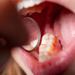 temporary filling of a patients dental caries set by a dentist for the treatment of gingivitis in the dentists office